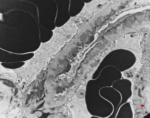 M,59y. | membranous glomerulopathy M,59y. | membranous glomerulopathy